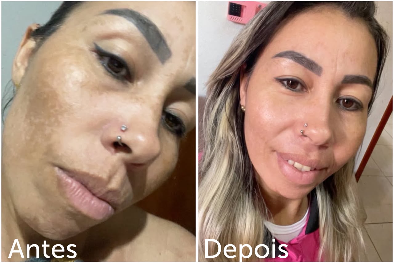 Duas fotos de rosto, com as legendas ‘Antes’ e ‘Depois’.